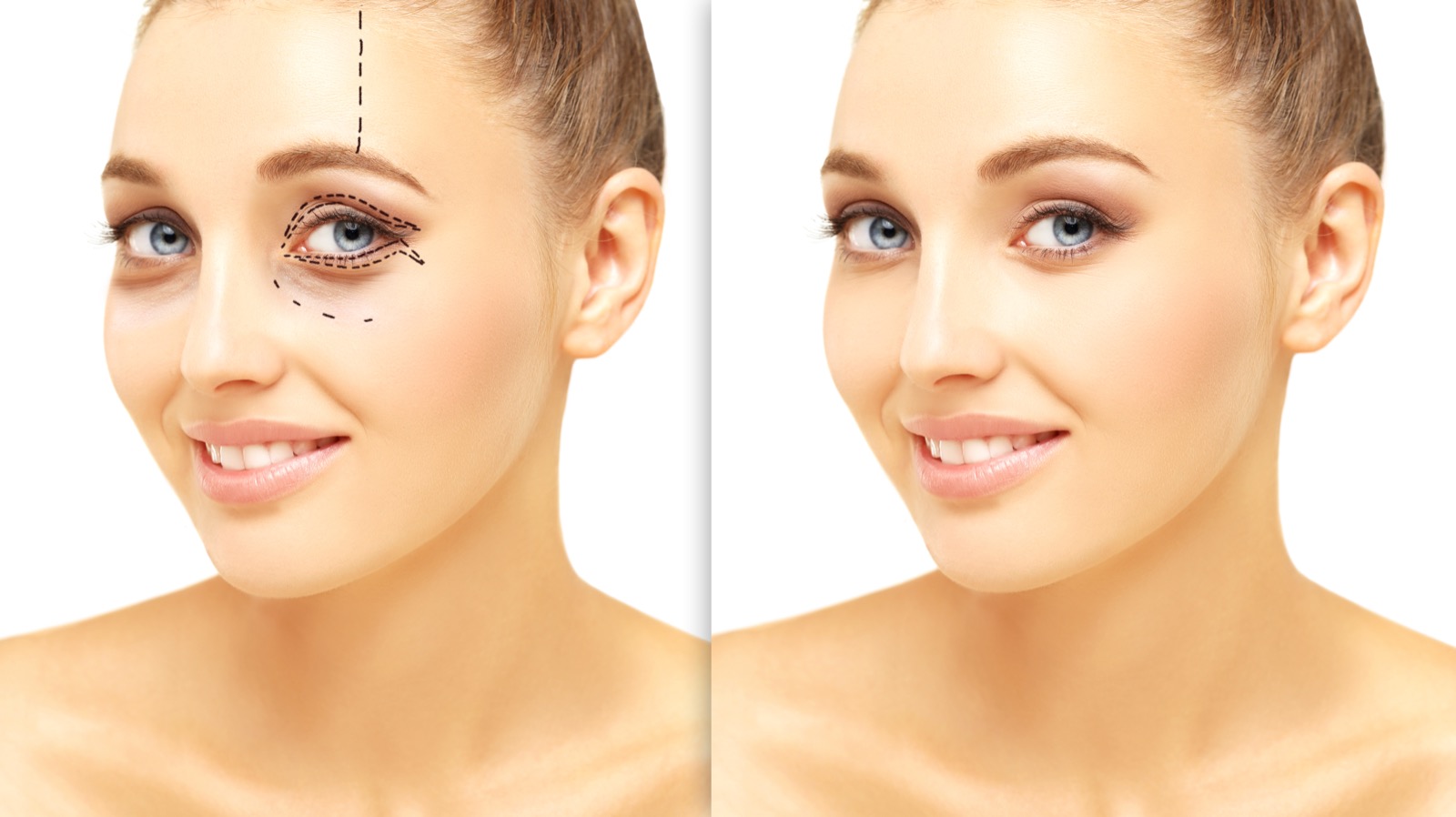 Pre-operative planning marks for a brow procedure