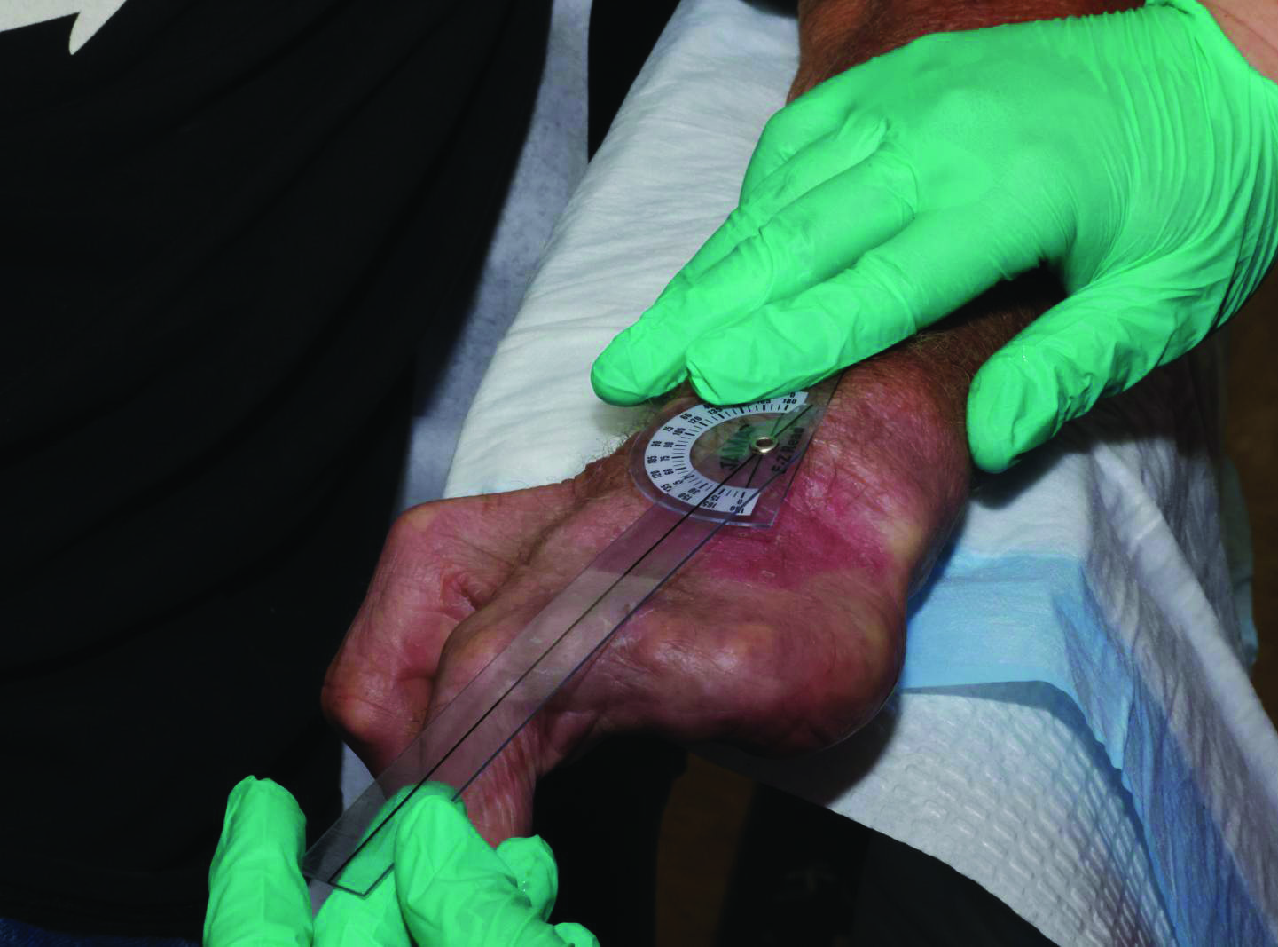 CO₂ laser skin resurfacing treatment