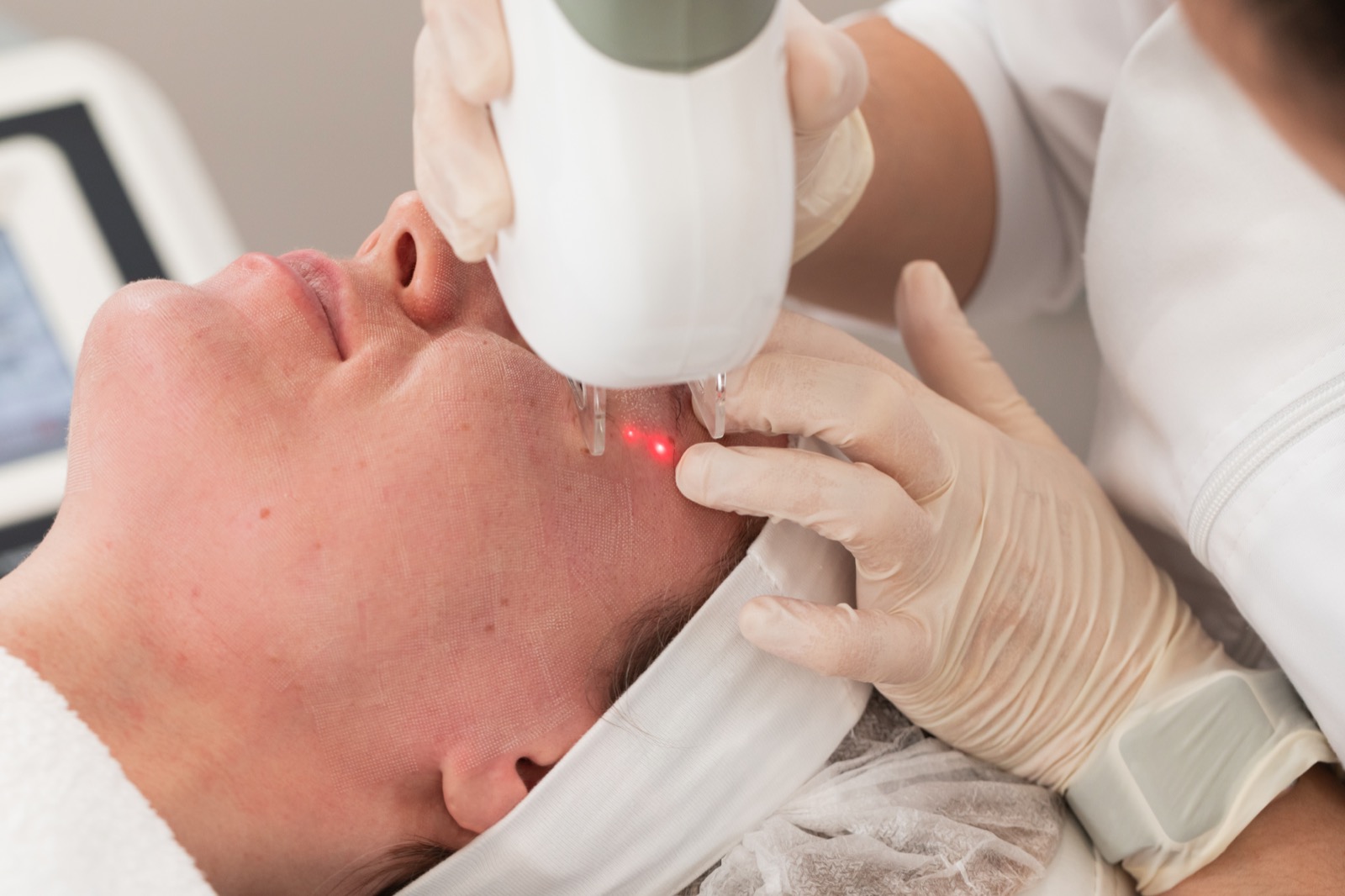 Laser treatment for pigmentation and scarring