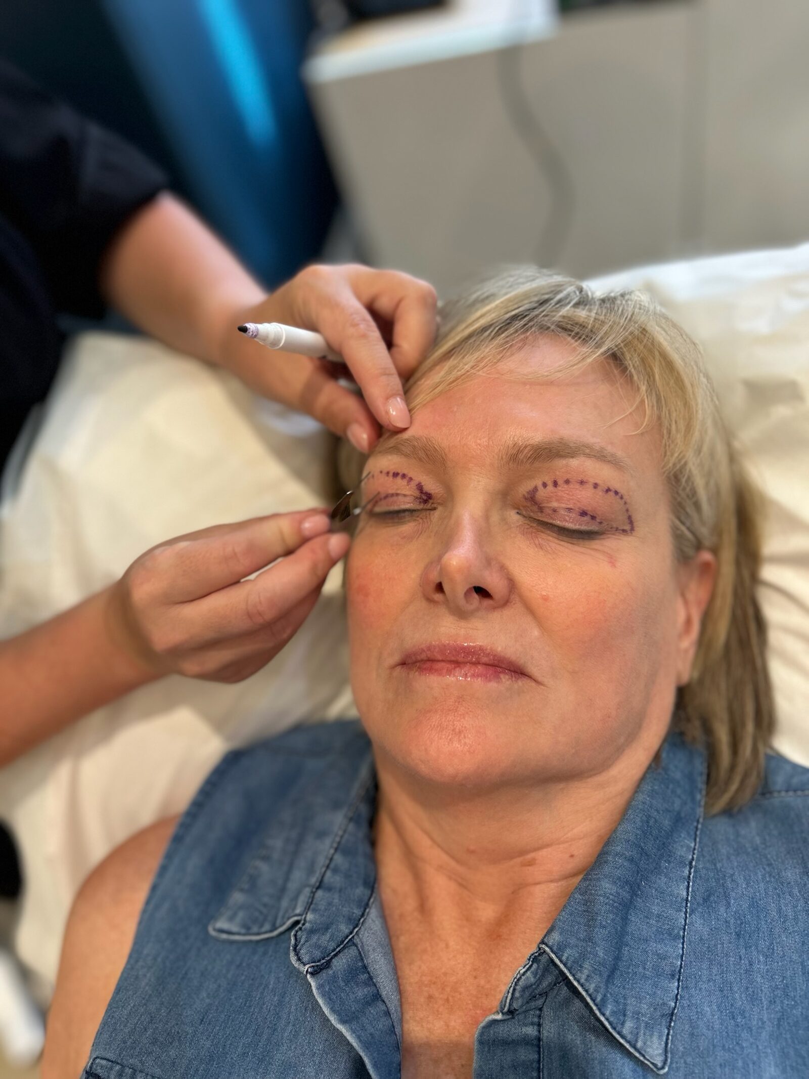 Pre-operative eyelid marking