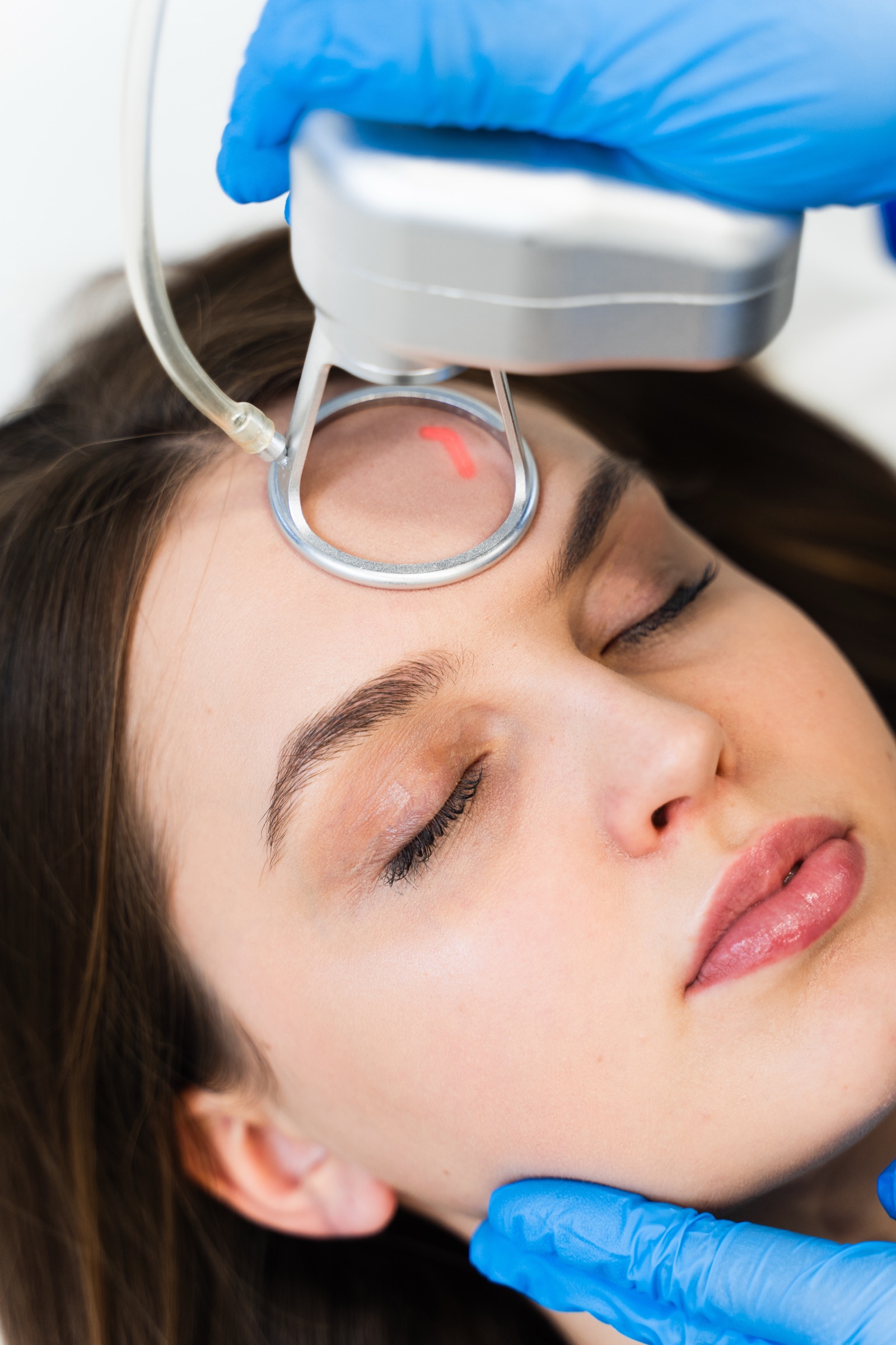 Laser treatment for pigmentation and scarring